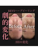 マヤヒメ(mayahime)/ニキビケア