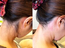 ドクターリバース(Dr.Reverse)/【うなじ脱毛】ワックス脱毛