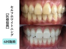 ベルホワイト(Belle White)/【医療提携W.N/6回】