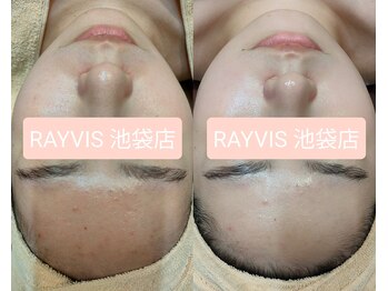 エステティック レイビス 池袋店(RAYVIS)/艶肌フェイシャル