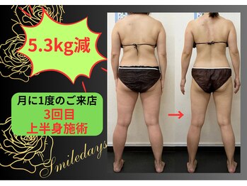 スマイルデイズ(Smiledays)/月に1度の施術でも、この通り！