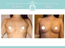 美人バスト 本厚木店/バストアップ◇症例◇