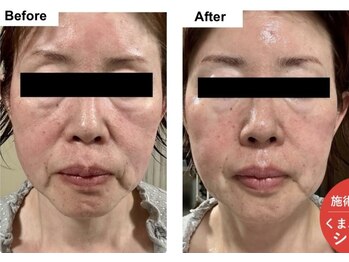 トゥルートラストディーバ 大里店(DIVA)/エクソソーム導入