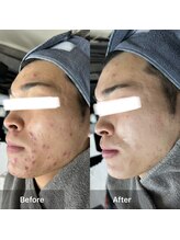 モカ 天王寺店(MOKA)/剥離　ハーブピーリング　予防