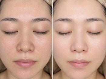 コンビンス(convince)の写真/毛穴が目立つ、ファンデが毛穴落ちする…毛穴洗浄×医療提携ピーリングで、毛穴・くすみのない透明肌へ。