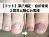 【定期メンテナンス】フット深爪矯正 2回目以降