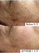 フェミニー(Feminy)/【ハーブ】着々とシミ改善