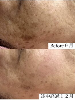 フェミニー(Feminy)/【ハーブ】着々とシミ改善