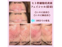 サロン ド ルビジューの雰囲気（◆大人ニキビ◆赤味顔◆肌質改善◆ヒト幹細胞培養液フェイシャル）