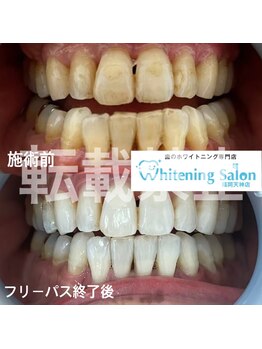 ホワイトニングサロン 福岡天神店/ホワイトニング