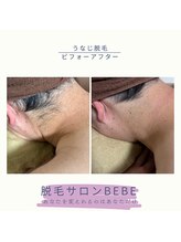 ベベ(Bebe)/うなじ脱毛♪