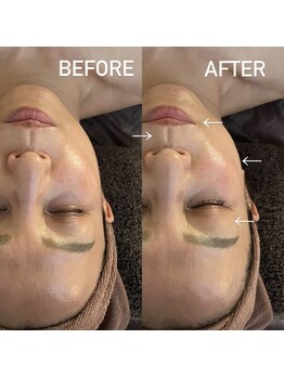 アンミー(anmiiy)/50代エアバリ変化/フェイシャル