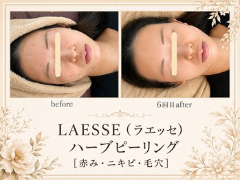 エスポワール(espoir)/赤み・赤ら顔にも効くハーブ！