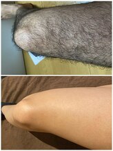 RBL 大宮店/足参考写真/足脱毛10回目剃毛後