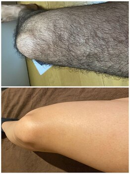 RBL 大宮店/足参考写真/足脱毛10回目剃毛後