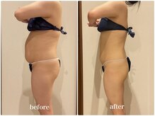 クラヴェル(Clavel)/30代前半セルゼロ2症例