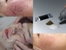 【爆速改善】スピキュール肌活性トリートメント【慢性悩みに】¥28000→15800