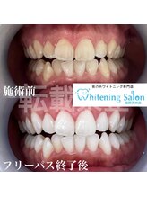ホワイトニングサロン 福岡天神店/ホワイトニング