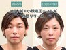 No.2【食いしばり・余白・左右差】120本美容鍼×小顔調整×コルギ120分
