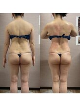 ソフィア わさだ店/30代セルゼロ半身コース10回