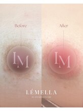 エルビービュティーサロン(LB BEAUTY SALON)/【ルメラ乳輪】実績数関西1★