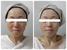 ティアス(t-us)/【美肌】ACトリートメント