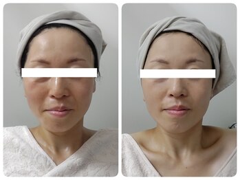 ティアス(t-us)/【美肌】ACトリートメント