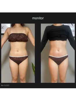 エヌボーテ(N. beaute)/お腹周りコース4回目