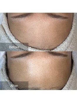 ホワイトアクア 天王寺本店(WHITE AQUA)/ララピール/大阪/天王寺/小顔