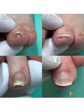 巻き爪補正店 つくば店/【巻き爪/陥入爪補正】