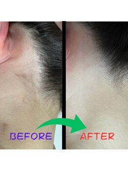 フェリッセ(FELISSE)/Before & After (うなじ)女性