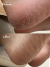 足裏角質ケア