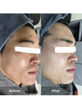 モカ 天王寺店(MOKA)/剥離 ハーブピーリング 予防