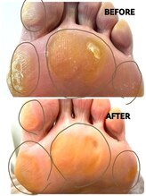 ラヴィ(La vie)/自己流角質ケアでガチガチ