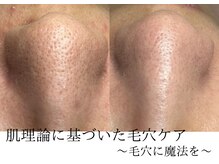 サロン イナンナ(Salon INANNA)/毛穴洗浄/毛穴引き締め