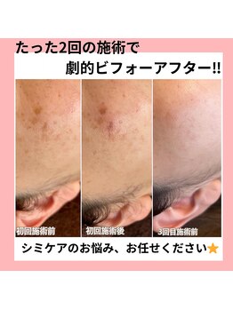 ハピネス(Hapiness)/シミケア◎！！