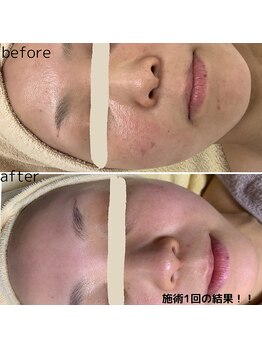 フォーユー マシバメディカル(For You Mashiba Medical)/３０代トーンアップ、毛穴が改善