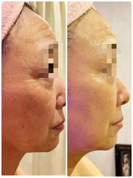 リアン(Riang)/ビフォーアフター