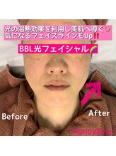 ハニーアイズ(Honey Eyes)/BBLフェイシャル