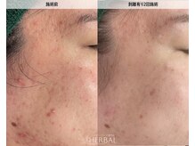 ハーバル 新宿店(HERBAL)/最強★韓国FCRハーブピーリング