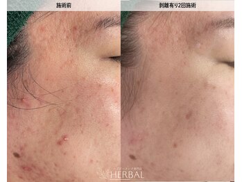 ハーバル 新宿店(HERBAL)/最強★韓国FCRハーブピーリング