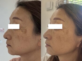 サクラ 本厚木駅前店(SAKURA)/本厚木シミケア/伊勢店シミケア