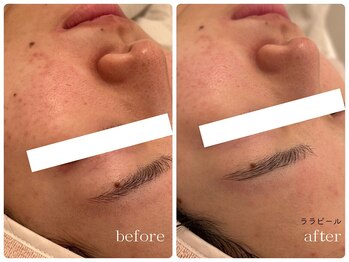 メゾンリュバン 天王寺(Maison Ruban)/ララピール|毛穴・ツヤ