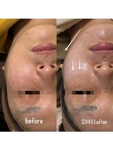 ミヨン(Miyong)/3週間後2回目施術