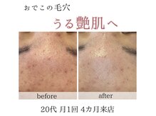 アネラ(Anela)/おでこのケア！