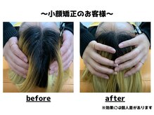 トータルビューティーみつとも/小顔矯正/インディバ/EMS