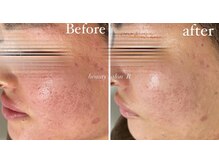 ビューティサロン アール(R)/放置してしまったお肌悩みも改善