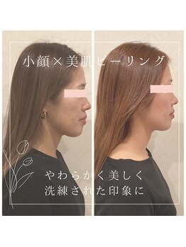 ソワン(soin)/小顔整顔×エステ×ピーリング