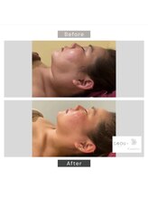 シーボウ(CBOU)/脂肪よう解　5ml(顔)