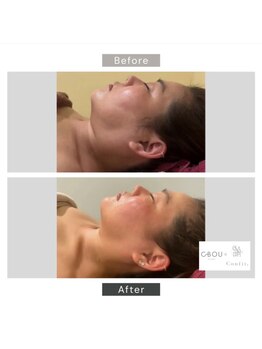 シーボウ(CBOU)/脂肪よう解　5ml(顔)